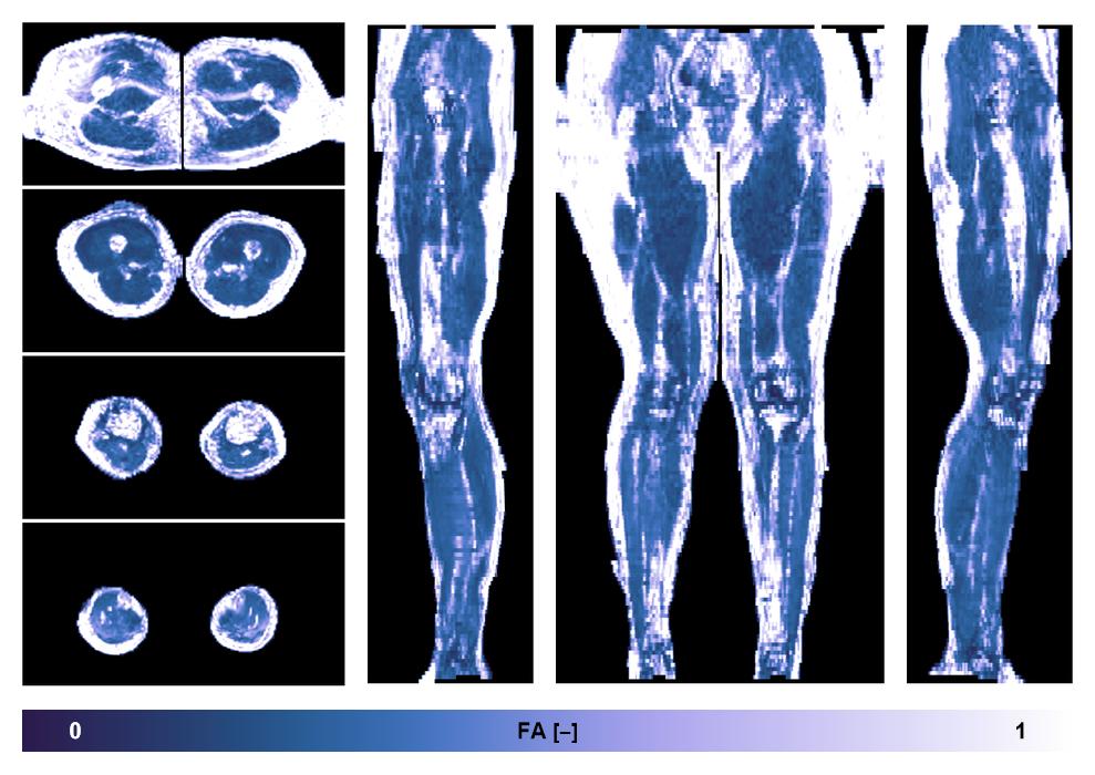 IVIM corrected whole leg muscle fractional anisotropy obtained from diffusion tensor imaging.